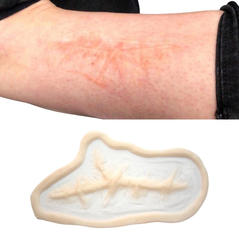 Keloid Scar 1