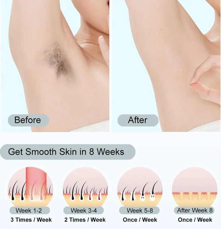 Laser Hair Removal At-Home for Women Men, 999,999 Flashes Painless IPL Hair Removal Device on Facial Legs Arms Bikini Line Comfort Silky ipl hairremoval 1